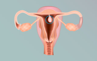 Pólipo Endometrial: sintomas, diagnóstico e tratamento