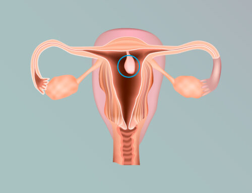 Pólipo Endometrial: sintomas, diagnóstico e tratamento