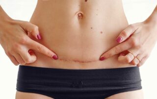 endometriose na cicatriz de cesárea
