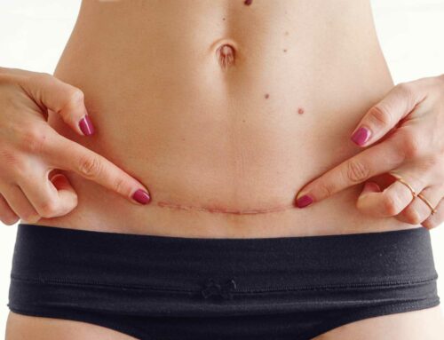 Entenda a endometriose na cicatriz de cesárea