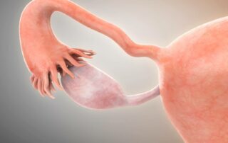 Conheça os tipos de cistos ovarianos