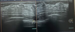 ultrassom de mamas